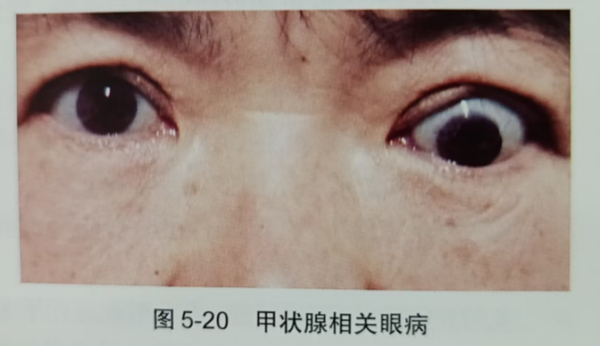 烟台眼镜技术培训的老师分享甲状腺相关性眼病